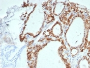 IHC staining of FFPE human thyroid tissue with recombinant Cadherin 16 antibody (clone CHD16/7027R) at 2ug/ml in PBS for 30min RT. Negative control inset: PBS used instead of primary antibody to control for secondary Ab binding. HIER: boil tissue sections in pH 9 10mM Tris with 1mM EDTA for 20 min and allow to cool before testing.