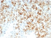 IHC staining of FFPE human kidney carcinoma tissue with recombinant Cdc20 antibody (clone CDC20/7026R) at 2ug/ml. HIER: boil tissue sections in pH 9 10mM Tris with 1mM EDTA for 20 min and allow to cool before testing.