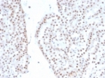 IHC staining of FFPE human renal oncocytoma with recombinant SF-1 antibody (clone NR5A1/4368R). HIER: boil tissue sections in pH 9 10mM Tris with 1mM EDTA for 20 min and allow to cool before testing.