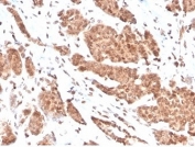 IHC staining of FFPE human breast carcinoma tissue with NME1 antibody (clone NME1/2737). HIER: boil tissue sections in pH 9 10mM Tris with 1mM EDTA for 20 min and allow to cool before testing.