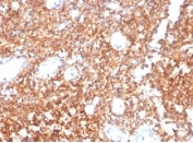 IHC staining of FFPE human tonsil tissue with CD20 antibody (clone MS4A1/4655). HIER: boil tissue sections in pH 9 10mM Tris with 1mM EDTA for 20 min and allow to cool before testing.