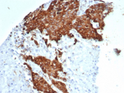 Beta Tubulin Antibody Ovarian Carcinoma IHC. Immunohistochemical analysis of Beta III tubulin (TUBB3) in formalin-fixed, paraffin-embedded human ovarian carcinoma using Beta Tubulin antibody clone TUBB3/7089R. Strong cytoplasmic staining is observed in tumor epithelial cells, consistent with TUBB3 expression in cancers with altered microtubule dynamics. The staining supports its use in studies of tumor phenotype and cytoskeletal organization.