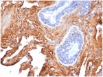 IHC staining of FFPE human lung tissue with Fibronectin 1 antibody (clone FN1/3569) at 2ug/ml in PBS for 30min RT. HIER: boil tissue sections in pH 9 10mM Tris with 1mM EDTA for 20 min and allow to cool before testing.