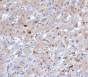IHC staining of FFPE human liver tissue with SERPINA3 antibody (clone SERPINA3/4190). HIER: boil tissue sections in pH 9 10mM Tris with 1mM EDTA for 20 min and allow to cool before testing.