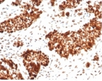 IHC staining of FFPE human ovarian carcinoma tissue with recombinant MSH6 antibody (clone MSH6/7065R). HIER: boil tissue sections in pH 9 10mM Tris with 1mM EDTA for 20 min and allow to cool before testing.