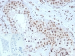IHC staining of FFPE human testis tissue with SF-1 antibody (clone NR5A1/3420) at 2ug/ml. Negative control inset: PBS instead of primary antibody to control for secondary binding. HIER: boil tissue sections in pH 9 10mM Tris with 1mM EDTA for 20 min and allow to cool before testing.
