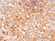 IHC staining of FFPE human liver tissue with Alpha-2-M antibody (clone A2M/3622). HIER: boil tissue sections in pH 9 10mM Tris with 1mM EDTA for 20 min and allow to cool before testing.