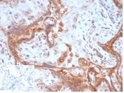 IHC staining of FFPE human placental tissue with Fibroblast Activation Protein Alpha antibody (clone FAP/4851). Negative control inset: PBS instead of primary antibody to control for secondary binding. HIER: boil tissue sections in pH 9 10mM Tris with 1mM EDTA for 20 min and allow to cool before testing.
