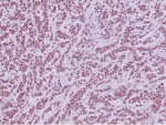 IHC staining of FFPE human sarcoma tissue with Integrase interactor 1 antibody (clone SMARCB1/4587R) HIER: boil tissue sections in pH 9 10mM Tris with 1mM EDTA for 20 min and allow to cool before testing.