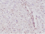 IHC staining of FFPE human epithelioid sarcoma with Integrase interactor 1 antibody (clone SMARCB1/4587R). HIER: boil tissue sections in pH 9 10mM Tris with 1mM EDTA for 20 min and allow to cool before testing.