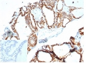 IHC staining of FFPE human thyroid tissue with recombinant CDH16 antibody (clone CHD16/7027R) at 2ug/ml in PBS for 30min RT. Negative control inset: PBS used instead of primary antibody to control for secondary Ab binding. HIER: boil tissue sections in pH 9 10mM Tris with 1mM EDTA for 20 min and allow to cool before testing.