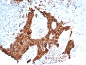 IHC staining of FFPE human ovarian carcinoma tissue with recombinant Tubulin Beta antibody (clone TUBB3/7090R). HIER: boil tissue sections in pH 9 10mM Tris with 1mM EDTA for 20 min and allow to cool before testing.