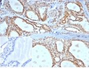 IHC staining of FFPE human thyroid tissue with Daxx antibody (clone PCRP-DAXX-5G11) at 2ug/ml. Negative control inset: PBS instead of primary antibody to control for secondary binding. HIER: boil tissue sections in pH 9 10mM Tris with 1mM EDTA for 20 min and allow to cool before testing.
