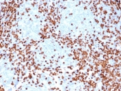 IHC staining of FFPE human thymus tissue with DNTT antibody (clone rDNTT/6909). HIER: boil tissue sections in pH 9 10mM Tris with 1mM EDTA for 20 min and allow to cool before testing.