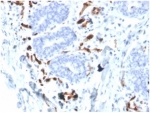 IHC staining of FFPE human breast carcinoma tissue with FABP4 antibody (clone FABP4/4426) at 2ug/ml in PBS for 30min RT. HIER: boil tissue sections in pH 9 10mM Tris with 1mM EDTA for 20 min and allow to cool before testing.