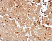 IHC staining of FFPE human liver cancer metastasized to colon tissue with recombinant Fatty Acid Binding Protein 5 antibody (clone FABP5/6353R). HIER: boil tissue sections in pH 9 10mM Tris with 1mM EDTA for 20 min and allow to cool before testing.