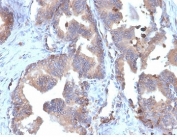 IHC staining of FFPE human prostate carcinoma tissue with recombinant Fatty Acid Binding Protein 5 antibody (clone FABP5/6353R). HIER: boil tissue sections in pH 9 10mM Tris with 1mM EDTA for 20 min and allow to cool before testing.