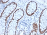 IHC staining of FFPE human colon tissue with SATB2 antibody (clone rSATB2/6929) at 2ug/ml in PBS for 30min RT. Strong nuclear staining is observed. HIER: boil tissue sections in pH 9 10mM Tris with 1mM EDTA for 20 min and allow to cool before testing.