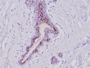 IHC staining of FFPE human lobular breast carcinoma tissue with GATA Binding Protein 3 antibody (clone GATA3/6664). HIER: boil tissue sections in pH 9 10mM Tris with 1mM EDTA for 20 min and allow to cool before testing.