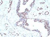 IHC staining of FFPE human prostate carcinoma tissue with FOXP1 antibody (clone rFOXP1/6902) [1ug/ml in PBS] for 30min RT. HIER: boil tissue sections in pH 9 10mM Tris with 1mM EDTA for 20 min and allow to cool before testing.