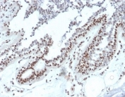 IHC staining of FFPE human breast carcinoma tissue with NM23 antibody (clone NME1/2738). HIER: boil tissue sections in pH 9 10mM Tris with 1mM EDTA for 20 min and allow to cool before testing.