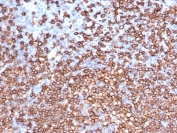 IHC staining of FFPE human lymph node with recombinant CD20 antibody (clone IGEL/6850R). HIER: boil tissue sections in pH 9 10mM Tris with 1mM EDTA for 20 min and allow to cool before testing.