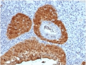 IHC staining of FFPE human cervix with CDKN2A antibody (clone rCDKN2A/4845). HIER: boil tissue sections in pH 9 10mM Tris with 1mM EDTA for 20 min and allow to cool before testing.