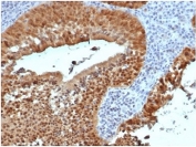 IHC staining of FFPE human cervical tissue with CDKN2A antibody (clone rCDKN2A/4845). HIER: boil tissue sections in pH 9 10mM Tris with 1mM EDTA for 20 min and allow to cool before testing.