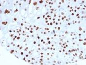 IHC staining of FFPE human colon carcinoma tissue with recombinant p21WAF1 antibody (clone rCIP1/6907) at 2ug/ml. HIER: boil tissue sections in pH 9 10mM Tris with 1mM EDTA for 20 min and allow to cool before testing.