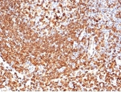 IHC staining of FFPE human lymph node tissue with CD74 antibody (clone CLIP/6609) at 2ug/ml. HIER: boil tissue sections in pH 9 10mM Tris with 1mM EDTA for 20 min and allow to cool before testing.