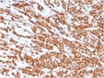 IHC staining of FFPE human colon carcinoma tissue with IL-2 antibody (clone IL2/3949). HIER: boil tissue sections in pH 9 10mM Tris with 1mM EDTA for 20 min and allow to cool before testing.