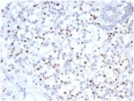 IHC staining of FFPE human kidney cancer tissue with recombinant p57Kip2 antibody (clone KIP2/7083R) at 2ug/ml in PBS for 30min RT. HIER: boil tissue sections in pH 9 10mM Tris with 1mM EDTA for 20 min and allow to cool before testing.