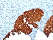 IHC staining of FFPE human cervix with recombinant p16INK4a antibody (clone CDKN2A/4844R). HIER: boil tissue sections in pH 9 10mM Tris with 1mM EDTA for 20 min and allow to cool before testing.