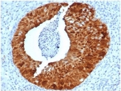 IHC staining of FFPE human cervical tissue with recombinant p16INK4a antibody (clone CDKN2A/4844R). HIER: boil tissue sections in pH 9 10mM Tris with 1mM EDTA for 20 min and allow to cool before testing.