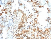 IHC staining of FFPE human lung carcinoma tissue with recombinant Cystic Fibrosis Transmembrane Regulator antibody (clone CFTR/7154R) at 2ug/ml. HIER: boil tissue sections in pH 9 10mM Tris with 1mM EDTA for 20 min and allow to cool before testing.