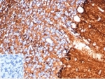 IHC staining of FFPE human brain tissue with S100B antibody (clone S100B/4138) at 2ug/ml. Negative control inset: PBS used instead of primary antibody to control for secondary Ab binding.