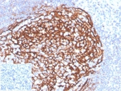 IHC staining of FFPE human tonsil tissue with recombinant CD21 antibody (clone CR2/3990R). Negative control inset: PBS instead of primary antibody to control for secondary binding. HIER: boil tissue sections in pH 9 10mM Tris with 1mM EDTA for 20 min and allow to cool before testing.