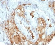 IHC staining of FFPE human colon carcinoma tissue with recombinant IL-2 antibody (clone IL2/7050R). HIER: boil tissue sections in pH 9 10mM Tris with 1mM EDTA for 20 min and allow to cool before testing.