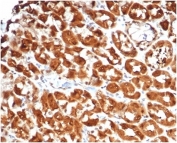 IHC staining of FFPE human colon carcinoma tissue with recombinant Interleukin 2 antibody (clone IL2/7051R). HIER: boil tissue sections in pH 9 10mM Tris with 1mM EDTA for 20 min and allow to cool before testing.