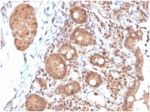 IHC staining of FFPE human colon carcinoma tissue with Interleukin 3 antibody (clone IL3/4004). HIER: boil tissue sections in pH 9 10mM Tris with 1mM EDTA for 20 min and allow to cool before testing.