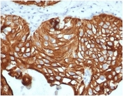 IHC staining of FFPE human bladder carcinoma tissue with recombinant KRT7 antibody (clone KRT7/4387R). HIER: boil tissue sections in pH 9 10mM Tris with 1mM EDTA for 20 min and allow to cool before testing.