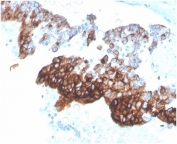 IHC staining of FFPE human ovarian carcinoma tissue with recombinant KRT7 antibody (clone KRT7/4387R). HIER: boil tissue sections in pH 9 10mM Tris with 1mM EDTA for 20 min and allow to cool before testing.