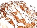 IHC staining of FFPE human lung carcinoma tissue with recombinant Surfactant Protein D (clone SFTPD/7084R). HIER: boil tissue sections in pH 9 10mM Tris with 1mM EDTA for 20 min and allow to cool before testing.