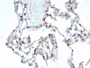 IHC staining of FFPE human lung carcinoma tissue with SFTPD (clone SFTPD/7086R). HIER: boil tissue sections in pH 9 10mM Tris with 1mM EDTA for 20 min and allow to cool before testing.