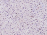 IHC staining of FFPE human epithelioid sarcoma tissue with SMARCB1 antibody (clone rSMARCB1/4588). Note loss of nuclear expression in tumor cells and retained positivity in normal cells. HIER: boil tissue sections in pH 9 10mM Tris with 1mM EDTA for 20 min and allow to cool before testing.