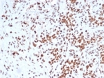 IHC staining of FFPE human Ewing sarcoma with SMARCB1 antibody (clone rSMARCB1/4588). HIER: boil tissue sections in pH 9 10mM Tris with 1mM EDTA for 20 min and allow to cool before testing.
