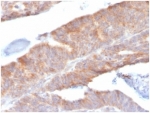 IHC staining of FFPE human colon tissue with IL1B antibody (clone IL1B/3993). HIER: boil tissue sections in pH 9 10mM Tris with 1mM EDTA for 20 min and allow to cool before testing.