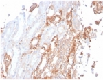 IHC staining of FFPE human renal cell carcinoma tissue with Alpha Fodrin antibody (clone SPTAN1/3506). HIER: boil tissue sections in pH 9 10mM Tris with 1mM EDTA for 20 min and allow to cool before testing.