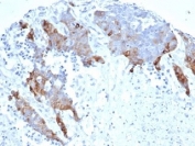 IHC staining of FFPE human ovarian carcinoma tissue with recombinant Transglutaminase 2 antibody (clone TGM2/6943R). HIER: boil tissue sections in pH 9 10mM Tris with 1mM EDTA for 20 min and allow to cool before testing.