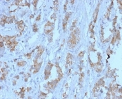 IHC staining of FFPE human ovarian carcinoma tissue with TDRKH antibody (clone PCRP-TDRKH-1H2) at 2ug/ml. HIER: boil tissue sections in pH 9 10mM Tris with 1mM EDTA for 20 min and allow to cool before testing.